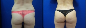 buttock-fat-transfer-2-4