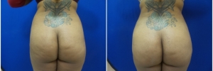 buttock-fat-transfer-3-1