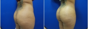 buttock-fat-transfer-3-2