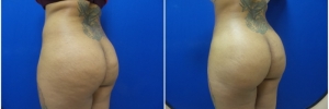 buttock-fat-transfer-3-3