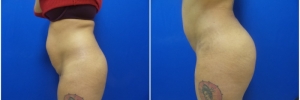 buttock-fat-transfer-3-4
