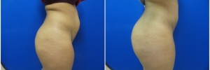 buttock-fat-transfer-3-5