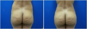 fat-transfer-before-after-photo-15-1