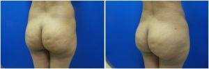 fat-transfer-before-after-photo-15-2