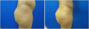 fat-transfer-before-after-photo-15-3