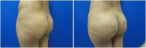 fat-transfer-before-after-photo-15-4