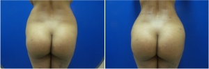 fat-transfer-before-after-photo-17-1