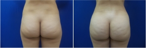 fat-transfer-before-after-photo-18-1