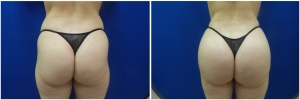 liposuction-fat-transfer-before-after-photo-14-2 copy