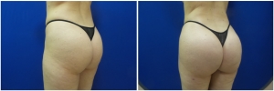 liposuction-fat-transfer-before-after-photo-14-3 copy