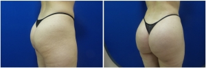 liposuction-fat-transfer-before-after-photo-14-4 copy
