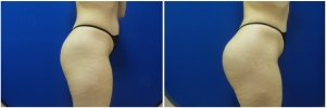 liposuction-fat-transfer-before-after-photo-14-5 copy