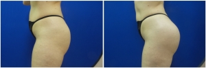 liposuction-fat-transfer-before-after-photo-14-6 copy