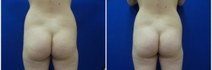 liposuction-fat-transfer-buttock1-1