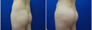 liposuction-fat-transfer-buttock1-2