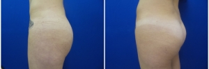 liposuction-fat-transfer-buttock1-3