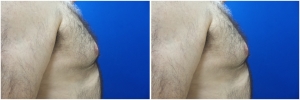 Gynecomastia-Before-After-NYC-1-1