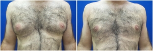 Gynecomastia-Before-After-NYC-1-2