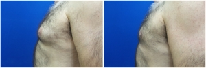 Gynecomastia-Before-After-NYC-1-3