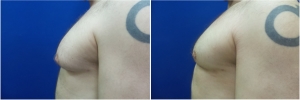 Gynecomastia-Before-After-NYC-4-1