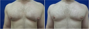 Gynecomastia-Before-After-NYC-4-2