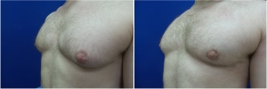 Gynecomastia-Before-After-NYC-4-3
