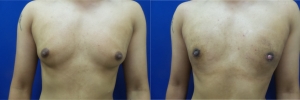 gynecomastia-before-after-photo-10-1