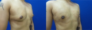 gynecomastia-before-after-photo-10-2