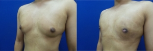 gynecomastia-before-after-photo-10-4