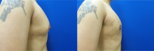 gynecomastia-before-after-photo-10-5