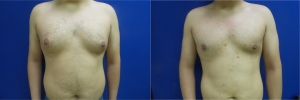 gynecomastia-before-after-photo-11-1
