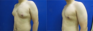 gynecomastia-before-after-photo-11-2
