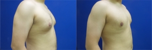 gynecomastia-before-after-photo-11-3