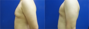 gynecomastia-before-after-photo-11-4