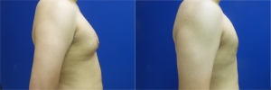 gynecomastia-before-after-photo-11-5