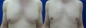 gynecomastia-before-after-photo-12-1
