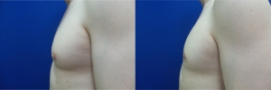 gynecomastia-before-after-photo-12-2