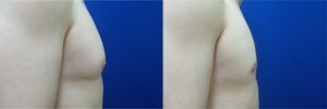 gynecomastia-before-after-photo-12-3
