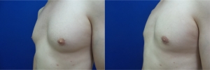 gynecomastia-before-after-photo-12-4