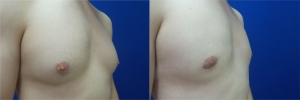 gynecomastia-before-after-photo-12-5