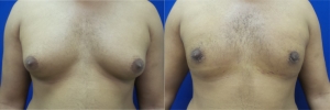 gynecomastia-before-after-photo-13-1