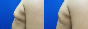 gynecomastia-before-after-photo-13-2