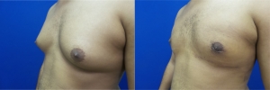 gynecomastia-before-after-photo-13-3
