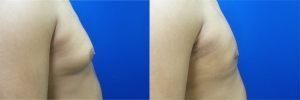 gynecomastia-before-after-photo-13-4