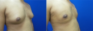 gynecomastia-before-after-photo-13-5