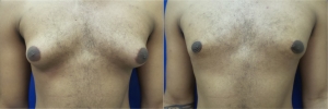 gynecomastia-before-after-photo-14-1