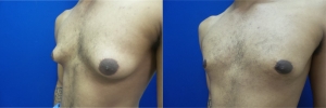 gynecomastia-before-after-photo-14-2