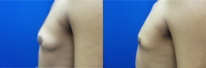 gynecomastia-before-after-photo-14-3