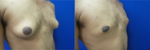 gynecomastia-before-after-photo-14-4