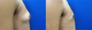 gynecomastia-before-after-photo-14-5